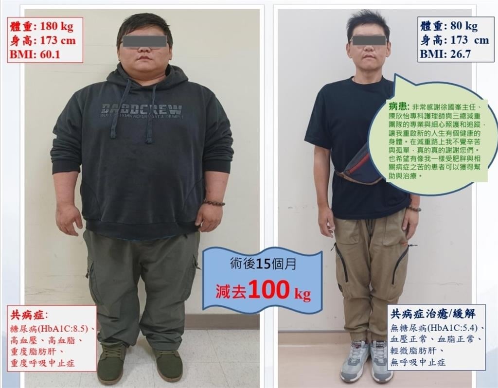 15個月減掉100公斤！　2嚴重肥胖個案靠手術+藥物成功瘦身