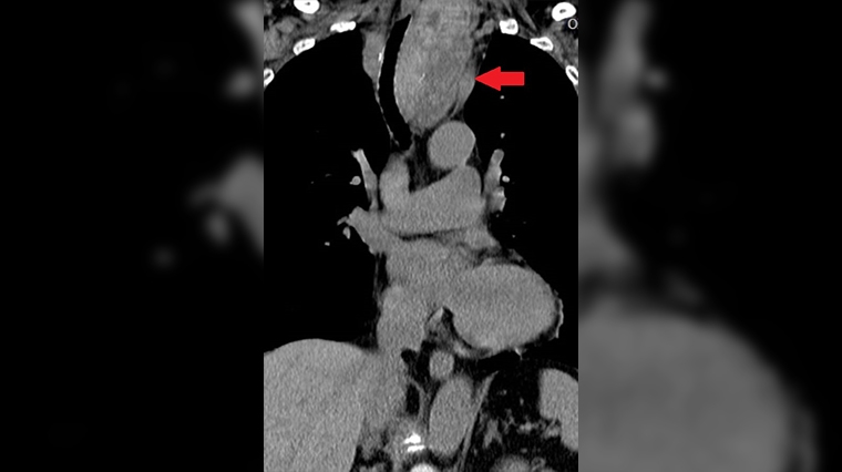 74歲婦人吞嚥困難 原來是甲狀腺結節腫如芭樂壓迫氣管