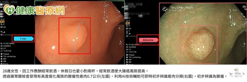 大腸癌年輕化警訊！28歲女業務應酬拚酒　健檢意外發現癌化高風險瘜肉