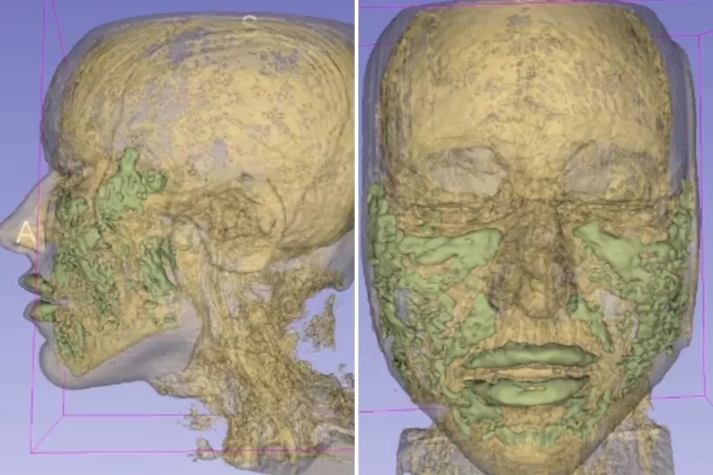 打玻尿酸六年後竟「吸水膨脹」？ 醫揭預防「延遲性發炎」4大關鍵