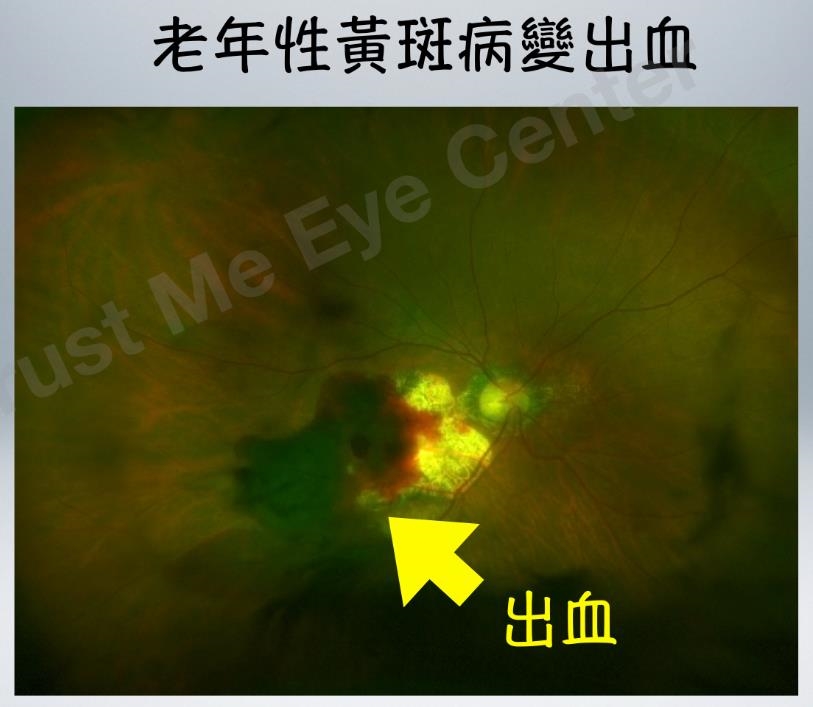 黃斑病變病情急轉直下！眼科醫師揭幕後元兇竟是「沒感覺」的高血壓