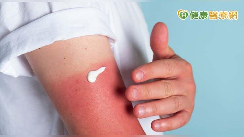 不愛美就不用管防曬？室內也有紫外線？醫揭反覆曬傷恐增罹皮膚癌機率！