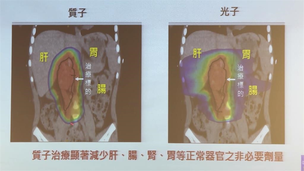 6歲女童罹神經母細胞瘤 精準「質子治療」助獲新生