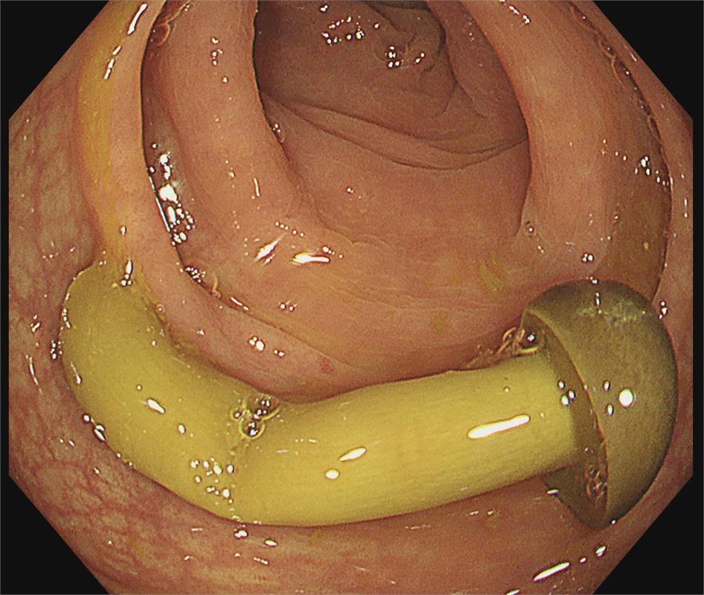照大腸鏡「驚見整根鴻喜菇」畫面超震撼!醫生一看嚇壞:吃東西要咬