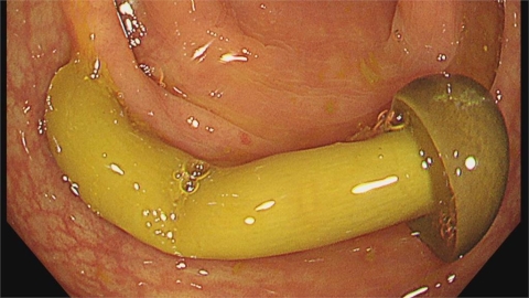 金針菇殘酷暱稱=「明天見」…照大腸鏡「整朵好好」醫:要咬啦!