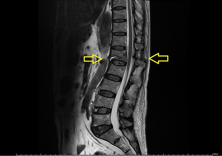 何謂屈曲牽張性骨折? 醫:脊椎前中後3結構全被破壞