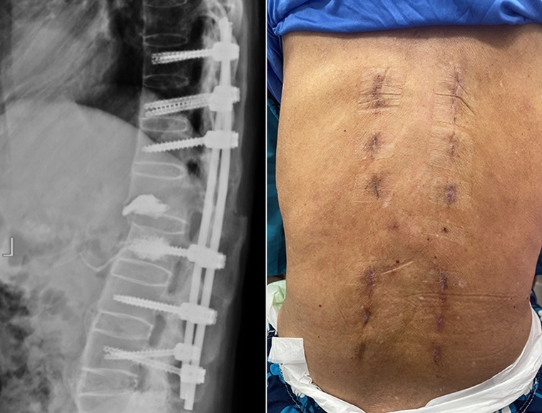 何謂屈曲牽張性骨折? 醫:脊椎前中後3結構全被破壞