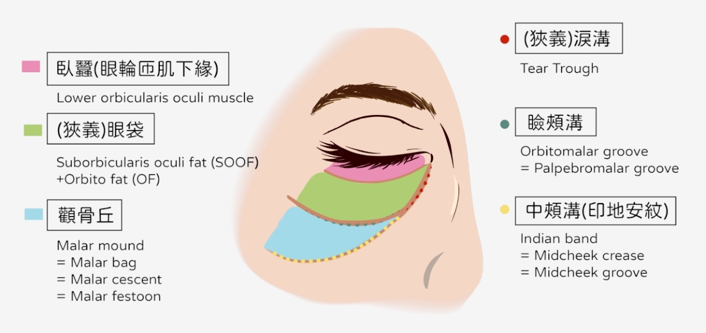 淚溝打完眼周腫成眼袋?醫揭「熊貓針vs玻尿酸」挑選訣竅:選錯針劑反而更顯老