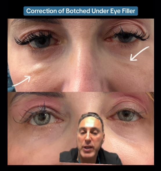 淚溝打完眼周腫成眼袋?醫揭「熊貓針vs玻尿酸」挑選訣竅:選錯針劑反而更顯老