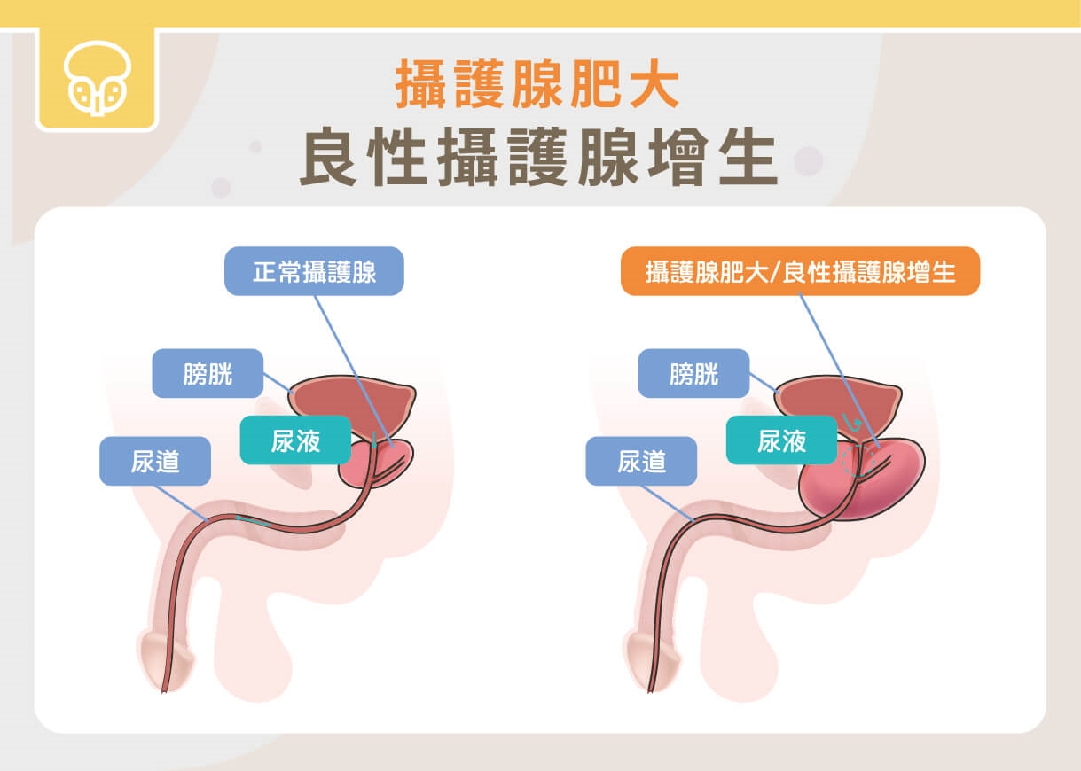 攝護腺肥大影響夜尿睡不好!手術怎麼選?一次看懂四種手術優缺點!