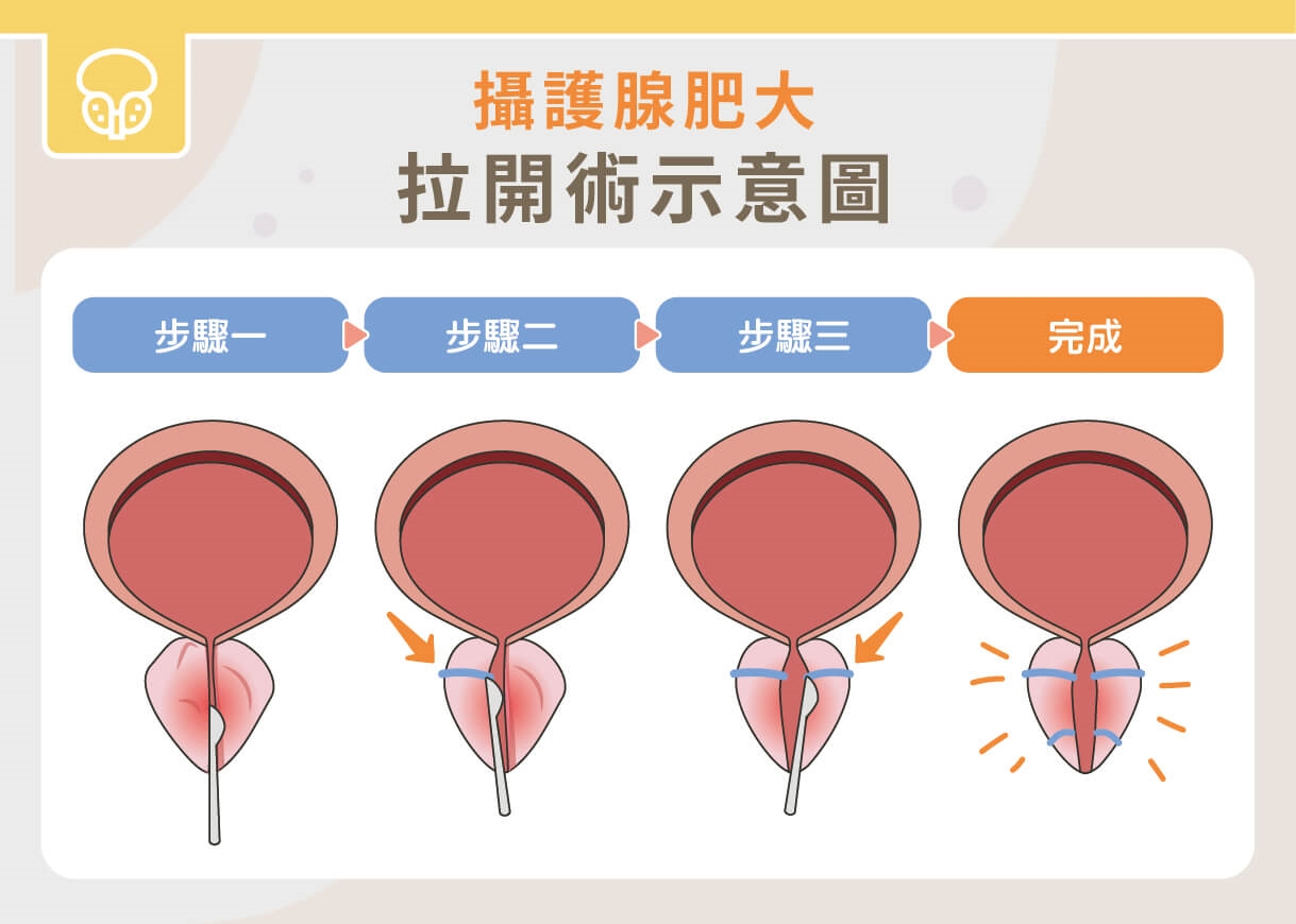 攝護腺肥大影響夜尿睡不好!手術怎麼選?一次看懂四種手術優缺點!