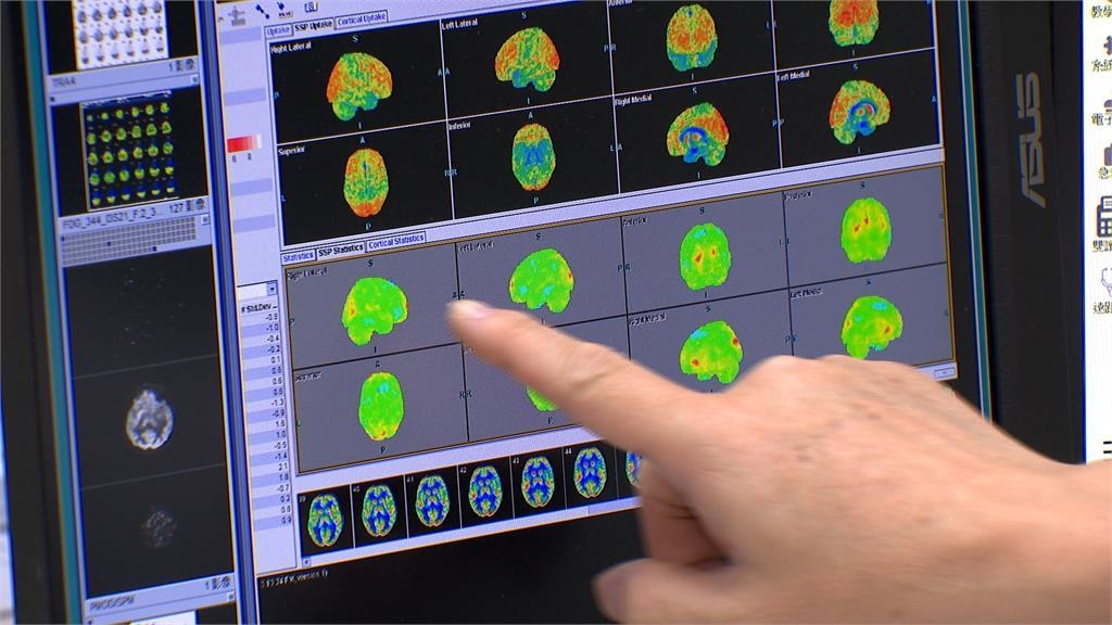 阿茲海默症新藥下周三施打！　一次療程需一年要價百萬