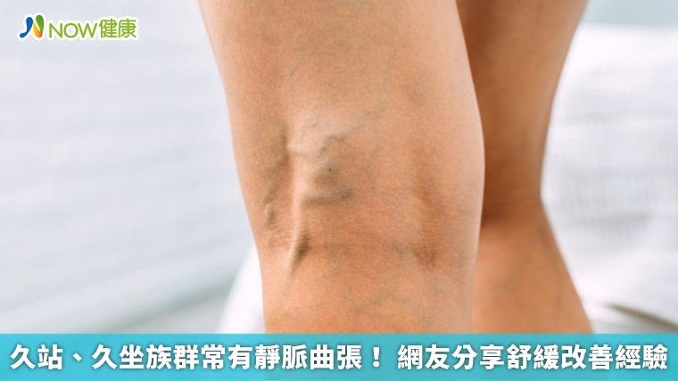 久站、久坐族群常有靜脈曲張！ 網友分享舒緩改善經驗