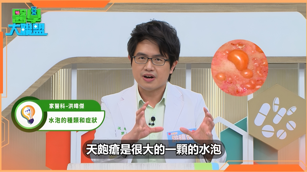 醫警:水泡出現勿當過敏!免疫拉警報3招教你預防之道