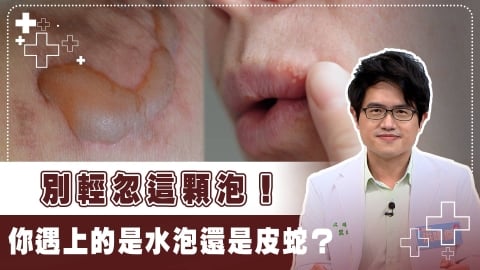 醫警：水泡出現勿當過敏！免疫拉警報3招教你預防之道