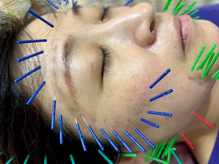 美顏針不動刀改善肌膚老化 愛美人士追求自然美新選擇