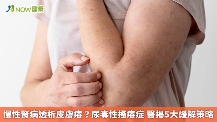 慢性腎病透析皮膚癢？尿毒性搔癢症 醫揭5大緩解策略