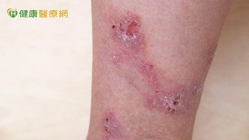 被蚊蟲咬想止癢別用偏方 醫師傳授夏季皮膚保養4原則 被蚊蟲咬想止癢別用偏方 醫師傳授夏季皮膚保養4原則