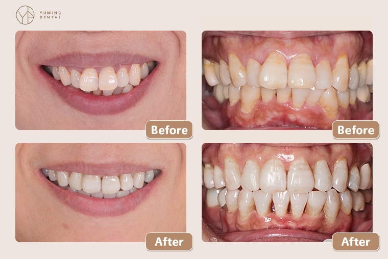 老年人從齒美麗重拾自信與尊嚴 銀髮族隱形矯正受青睞