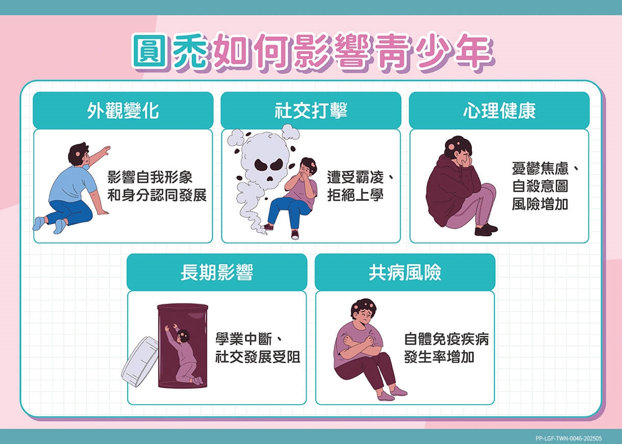 發現圓禿該怎麼辦？對抗圓禿應該瞭解的正確治療關鍵