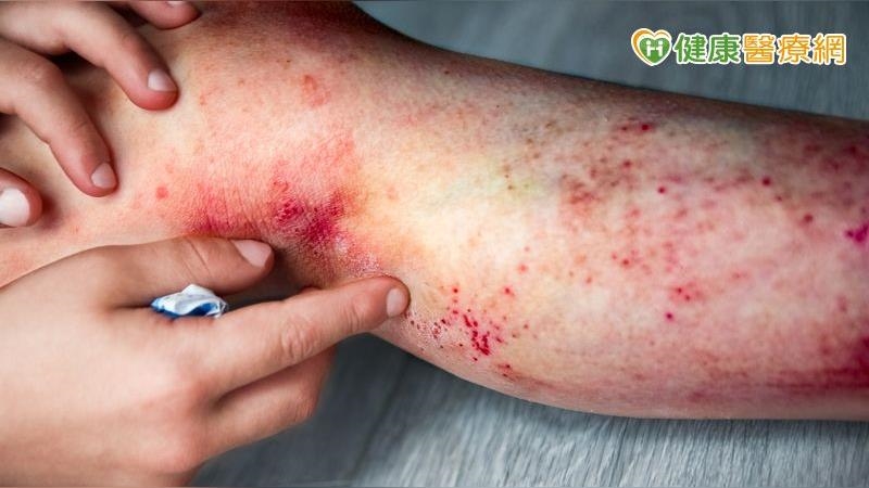 異位性皮膚炎能洗「漂白水」浴？　高醫推異膚中心個別化治療