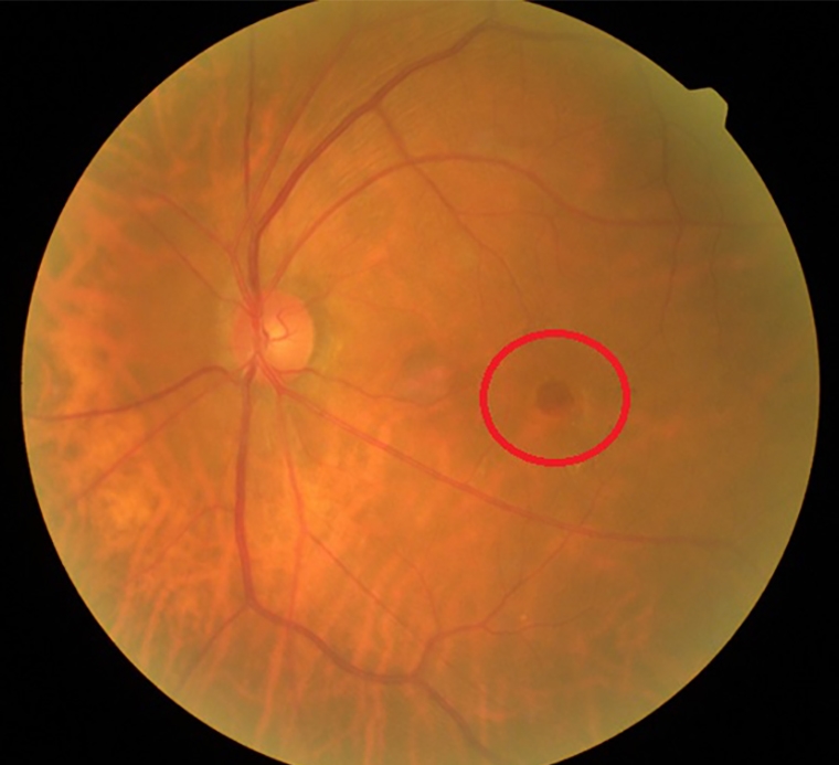 高齡看不清別再當老花或白內障 當心可能是黃斑部裂孔