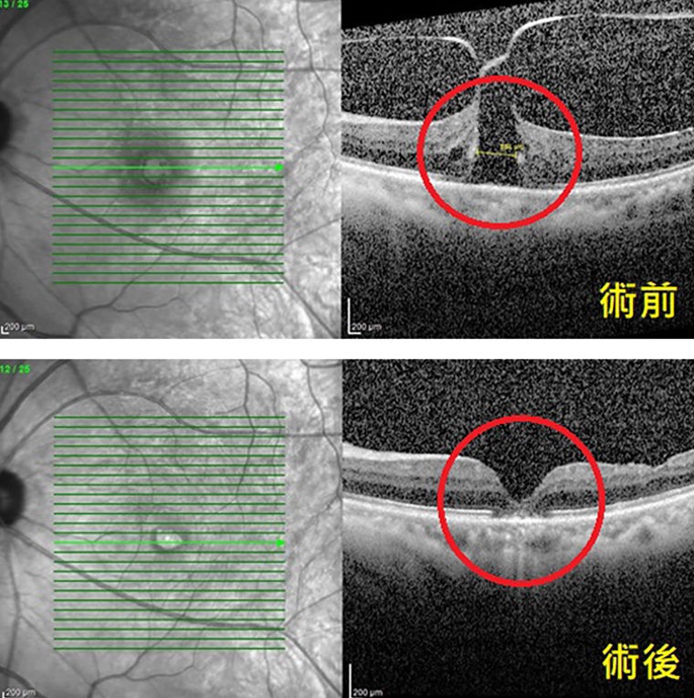 高齡看不清別再當老花或白內障 當心可能是黃斑部裂孔