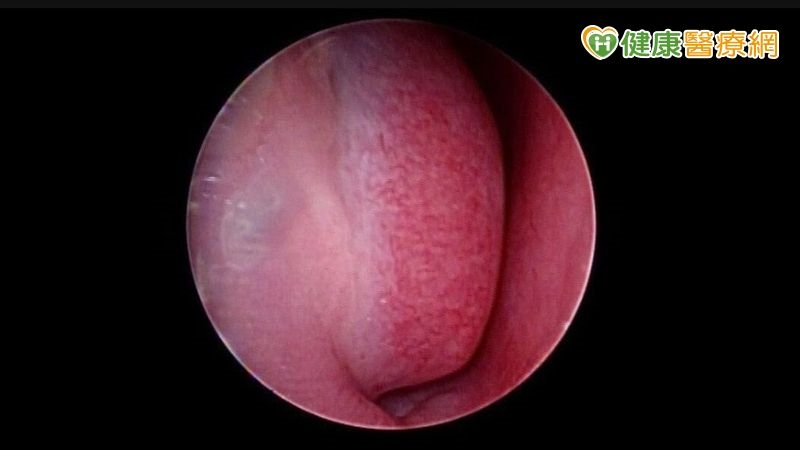 下鼻甲手術搭配膠原蛋白粉,減緩術後結痂困擾