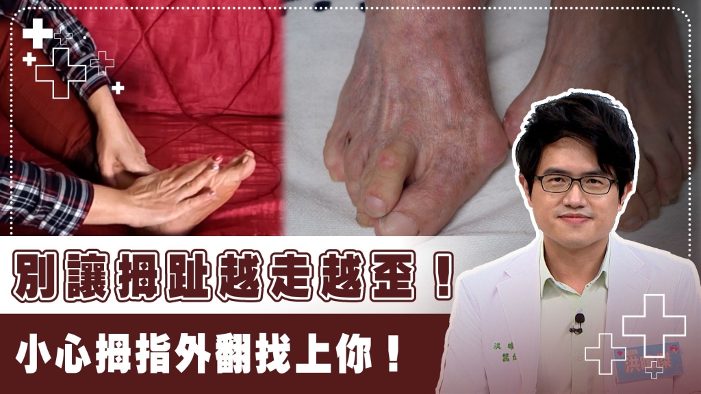 腳痛別輕忽!「拇指外翻」不只腳變形 醫曝:全身骨骼受力失衡連帶影響! 腳痛別輕忽!「拇指外翻」不只腳變形 醫曝:全身骨骼受力失衡連帶影響!