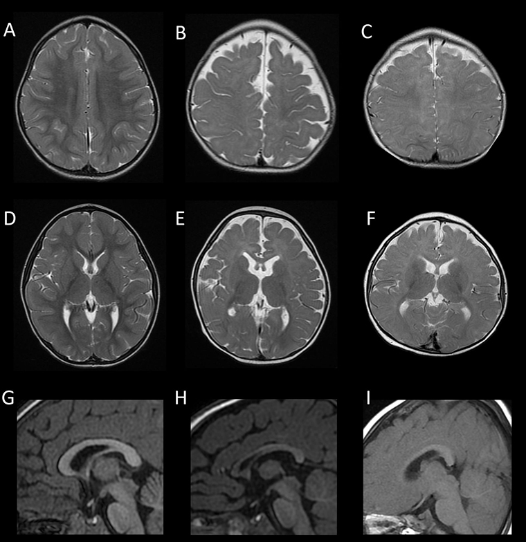 從癲癇到自閉症表現多樣 罕病腦部變異預測技術新突破