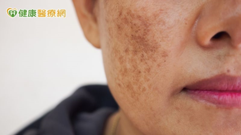 白斑、黑斑不痛不癢卻影響自信　皮膚科醫師解析色素異常治療方向