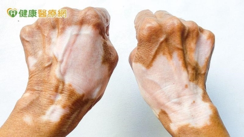 白斑、黑斑不痛不癢卻影響自信　皮膚科醫師解析色素異常治療方向
