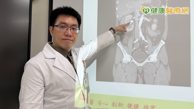 兩年三次腎結石 中年男腎出血後改「1手術」成功碎石