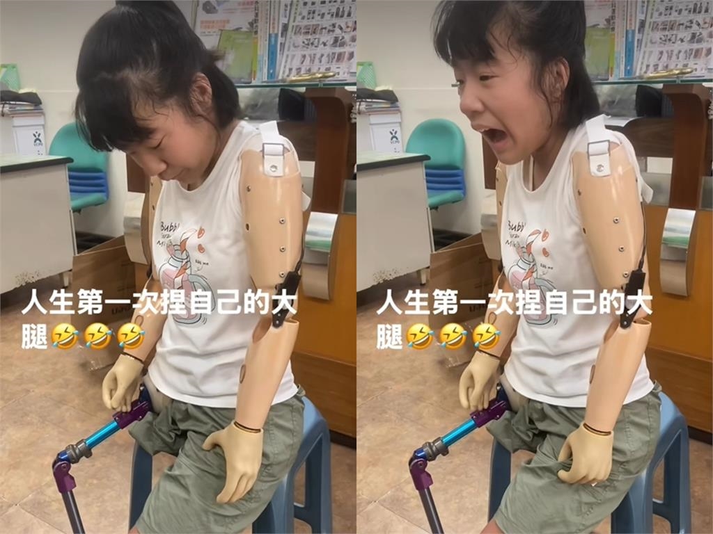 「單腳天使」徐又立裝義肢「首次與爸爸握手」畫面曝!父感動:等了12年