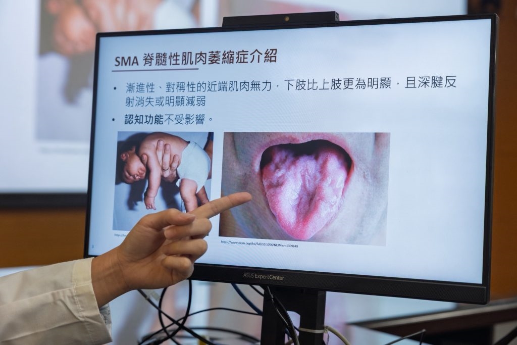 跨科團隊整合照護! 成大醫院邁入脊髓性肌肉萎縮症治療新里程