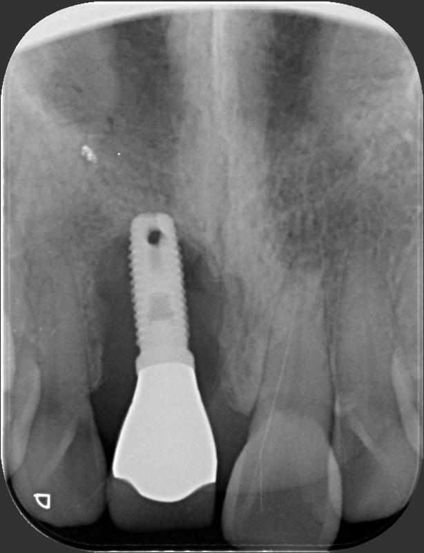 全口重建後就不會有牙周病? 沒做好4件事,「植體周圍炎」爆發更棘手