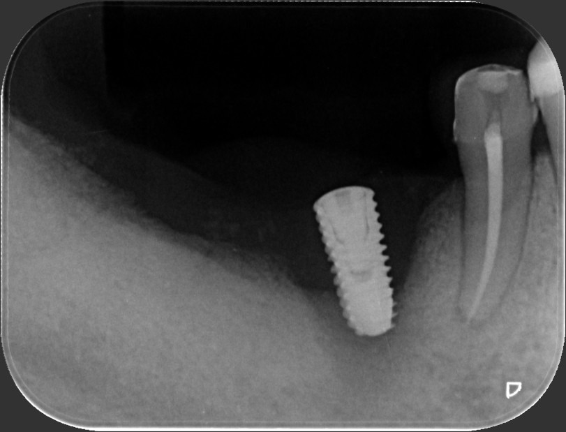 全口重建後就不會有牙周病? 醫:植體周圍炎爆發恐更棘手
