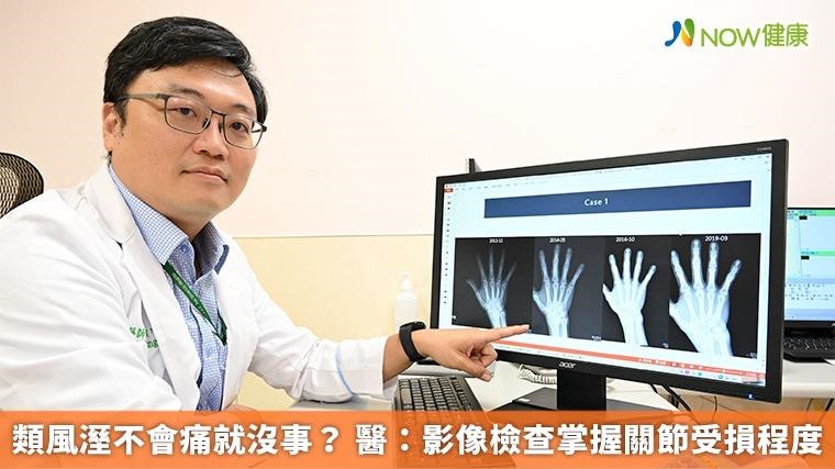 類風溼不會痛就沒事? 醫:影像檢查掌握關節受損程度 類風溼不會痛就沒事? 醫:影像檢查掌握關節受損程度
