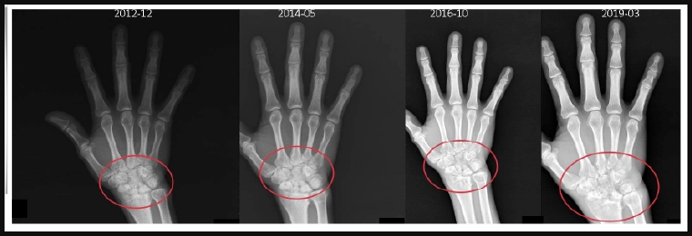 類風溼不會痛就沒事? 醫:影像檢查掌握關節受損程度