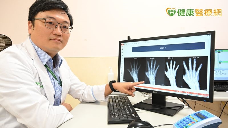 類風濕性關節炎不是不痛就沒事！　醫破解迷思：骨頭恐已悄悄被侵蝕