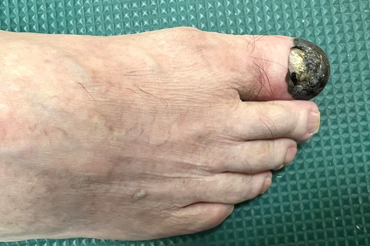 皮膚癌年增2千例！ 出現黑色斑塊、邊界不規則勿輕忽