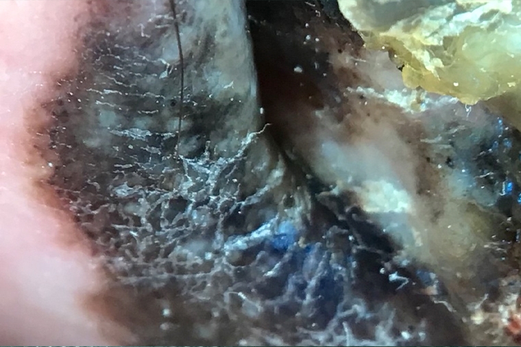 皮膚癌年增2千例！ 出現黑色斑塊、邊界不規則勿輕忽