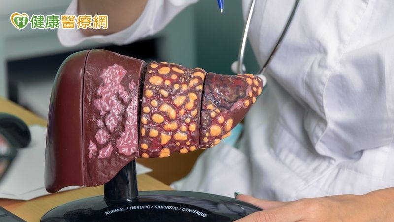 晚期肝癌無法動手術　醫用「這1方式」縮小腫瘤、重拾手術機會