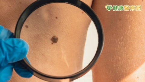 右腳大拇指出現黑塊以為是瘀青　一查竟是皮膚癌