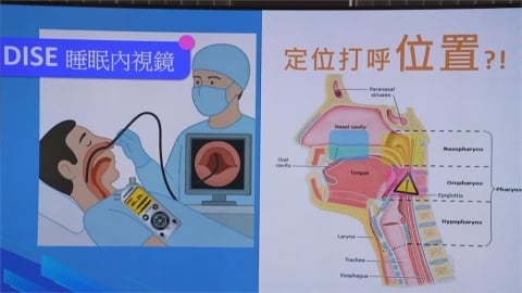 睡眠品質大提升！　達文西止鼾手術改善打呼困擾