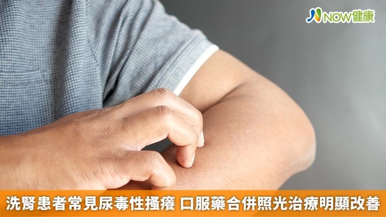 洗腎患者常見尿毒性搔癢 口服藥合併照光治療明顯改善