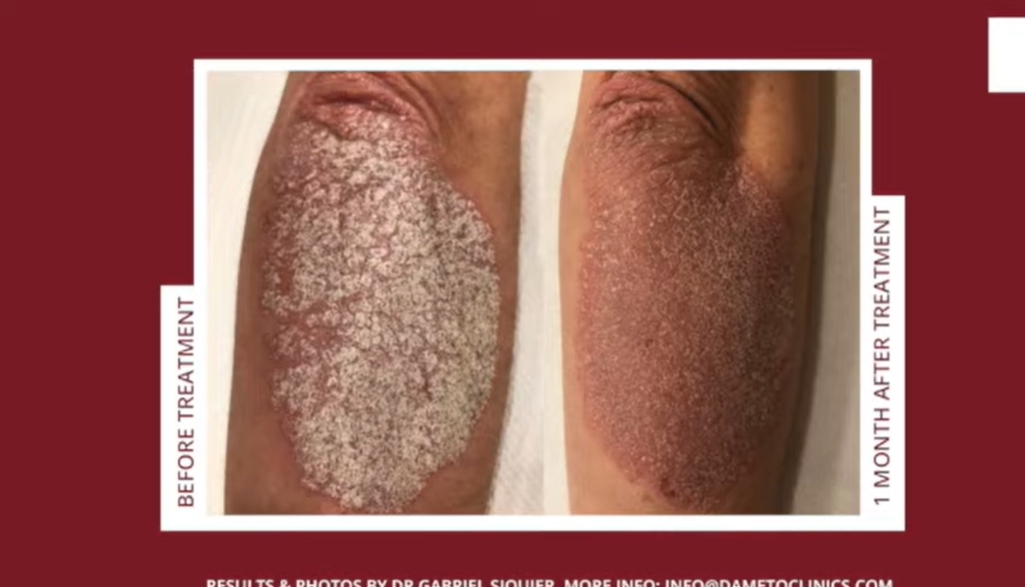 不只抗老!曾馨瑩公益代言Profhilo逆時針關鍵:「液態電波」重塑肌膚健康新紀元