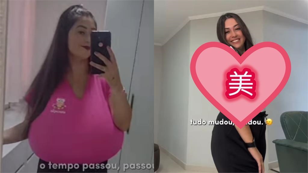 巴西22歲少女苦頂「12公斤巨胸」　患巨乳症募資縮胸10kg重拾自信