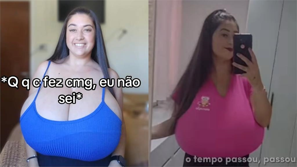 巴西22歲少女苦頂「12公斤巨胸」 患巨乳症募資縮胸10kg重拾自信