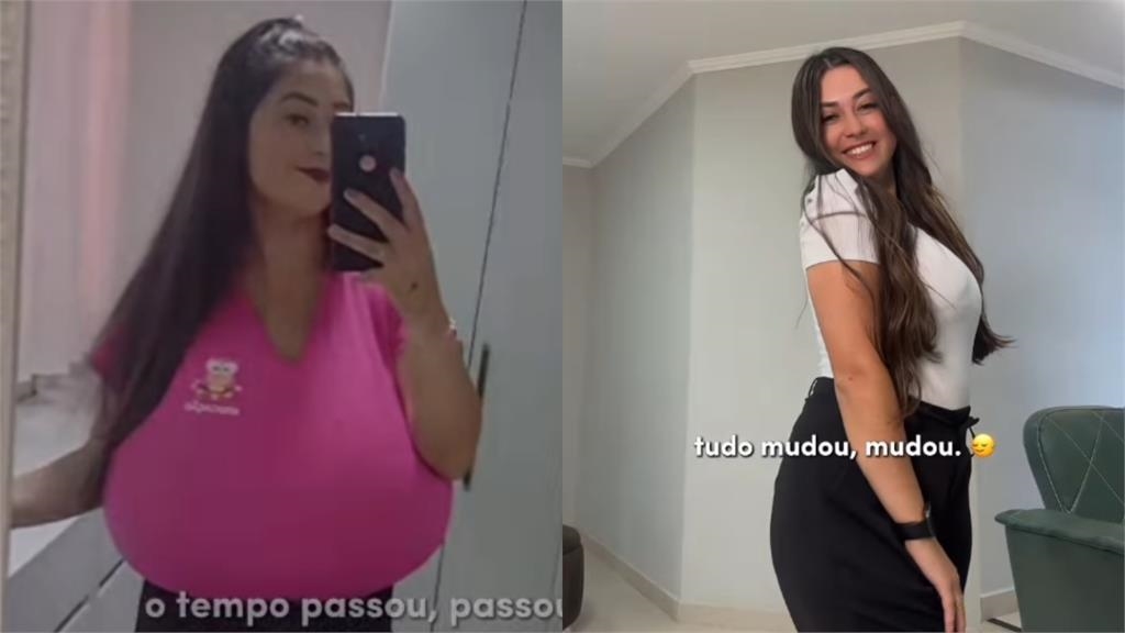 巴西22歲少女苦頂「12公斤巨胸」 患巨乳症募資縮胸10kg重拾自信